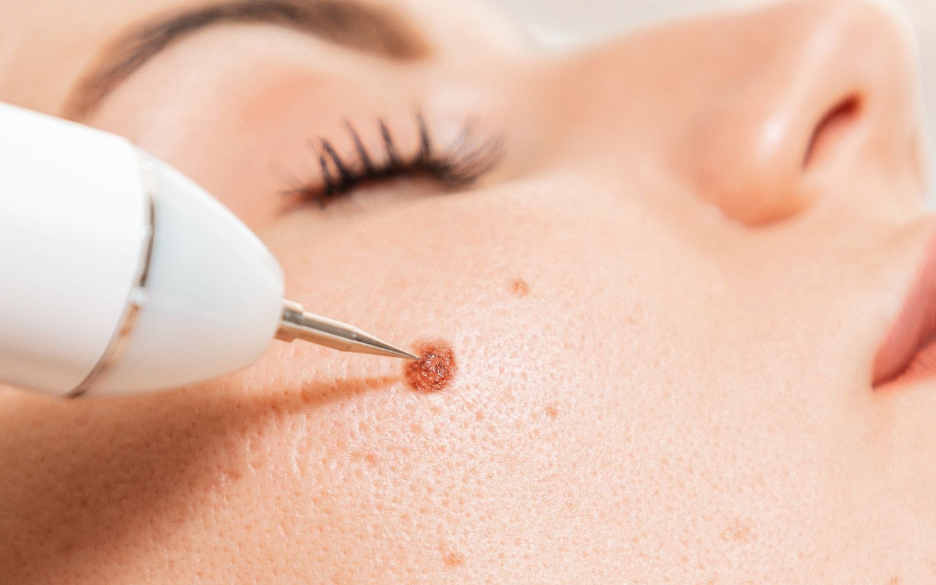 Remoción de verrugas